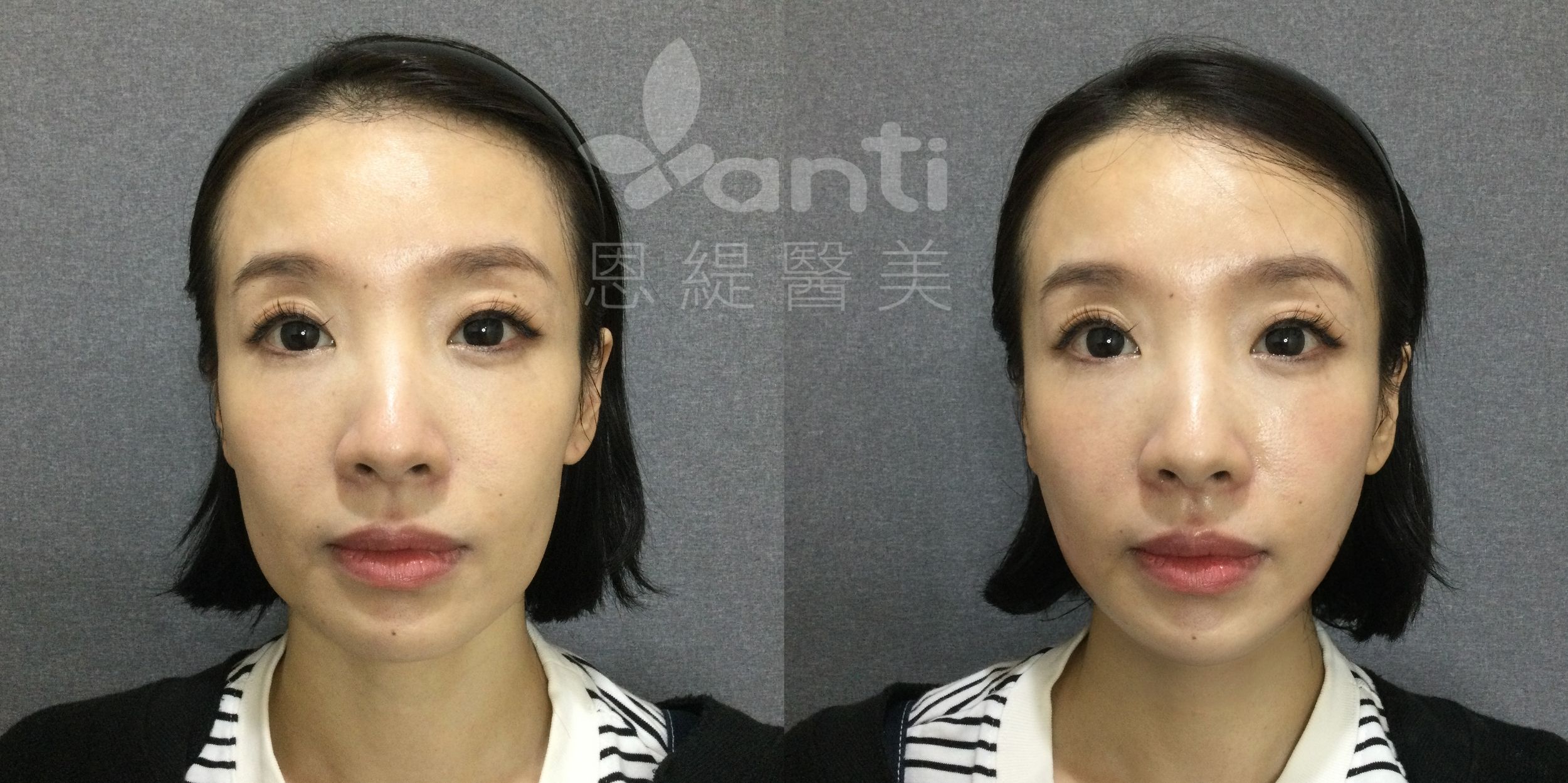onda pro 3次療程，緊實小臉
