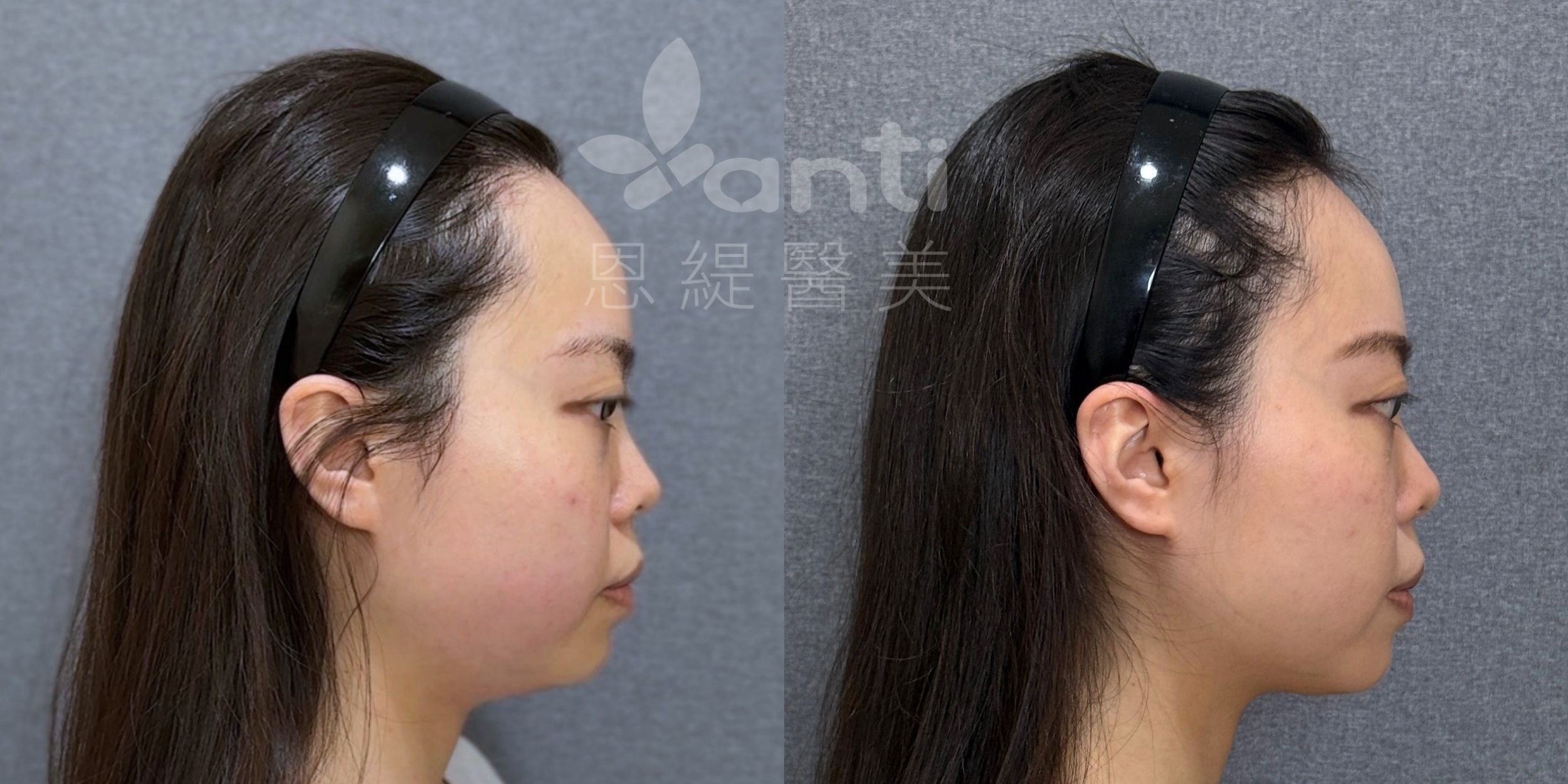 onda pro 2次療程，瘦雙下巴有感